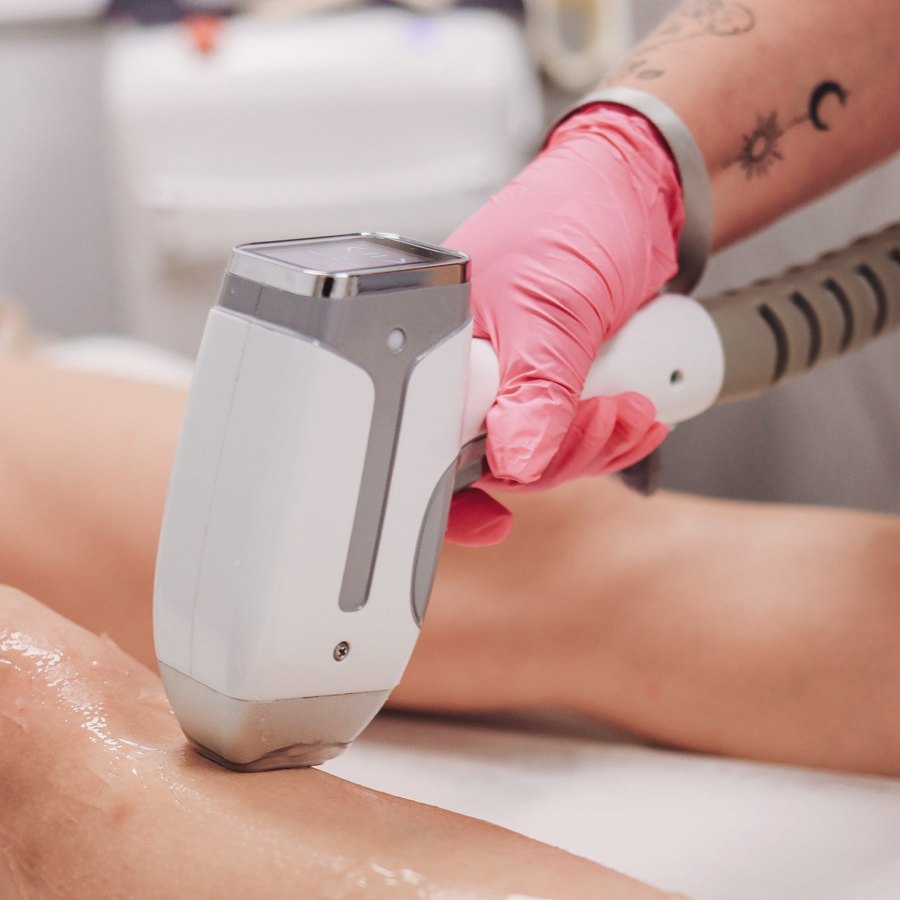 Sessão de depilação a laser na perna