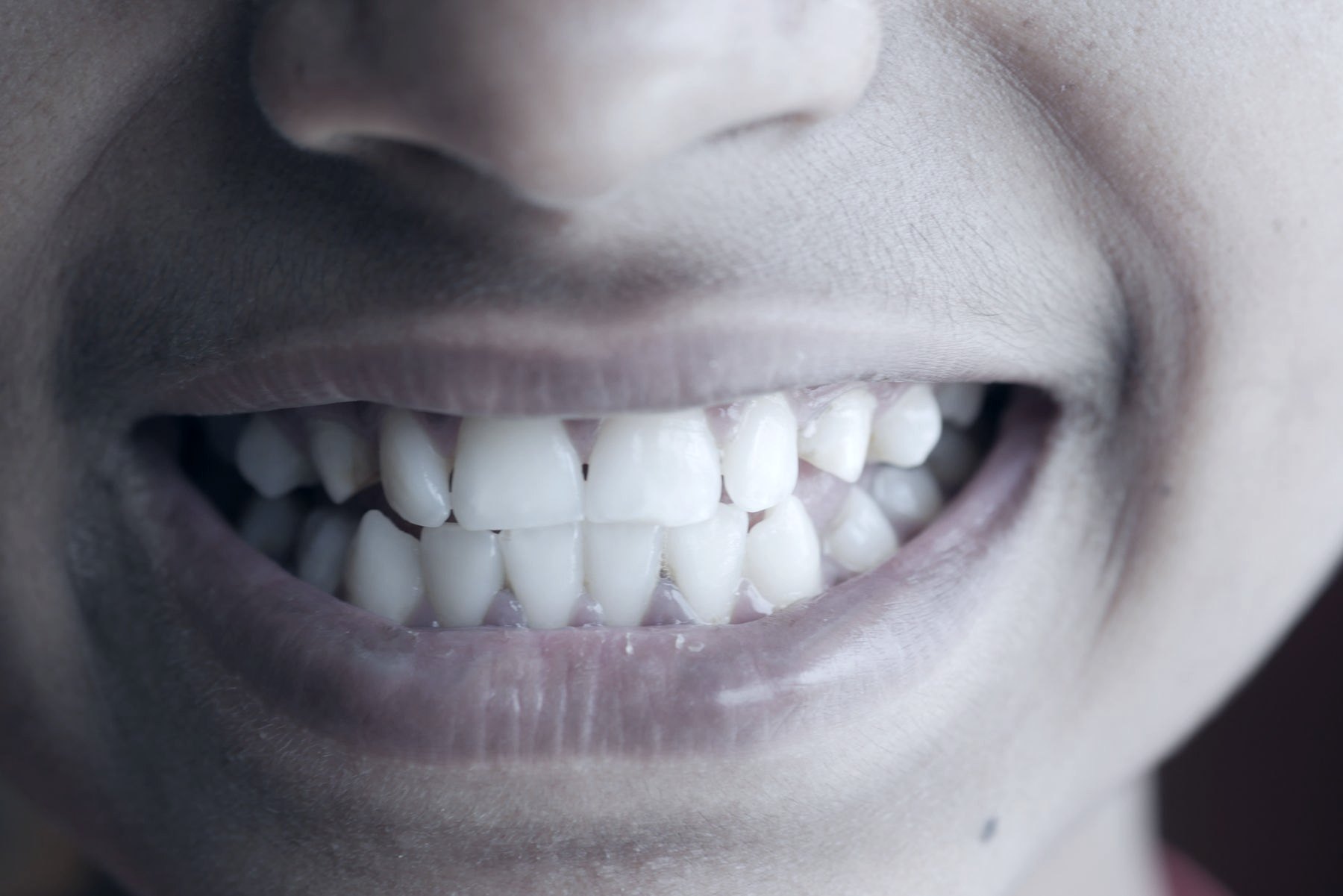 Close de sorriso com dentes alinhados