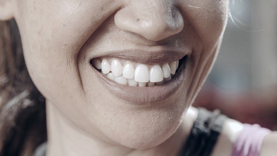 Close de um sorriso após tratamento estético